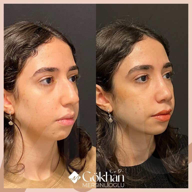 rhinoplasty-before-after