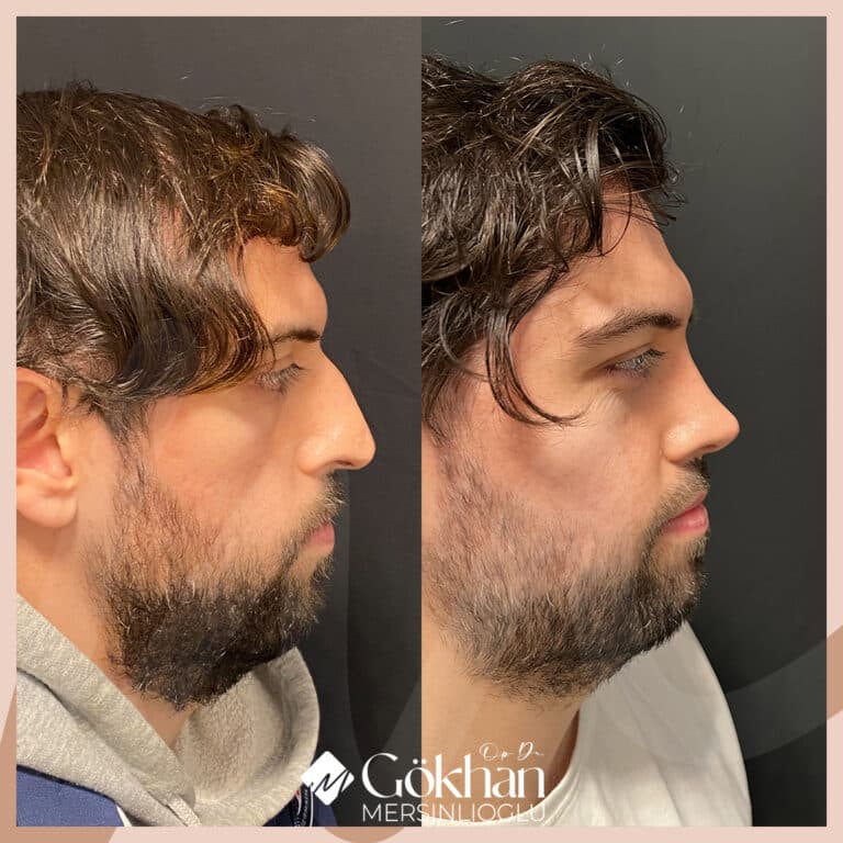 rhinoplasty-before-after