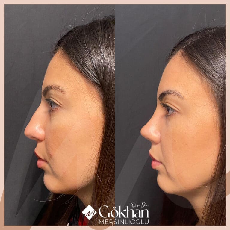 rhinoplasty-before-after