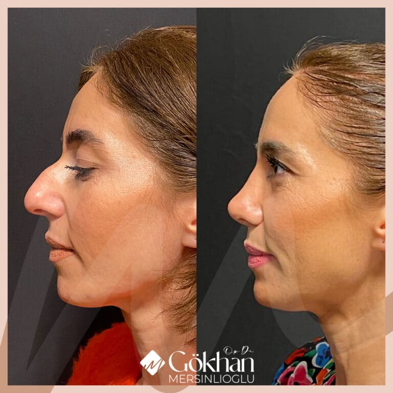 rhinoplasty-before-after