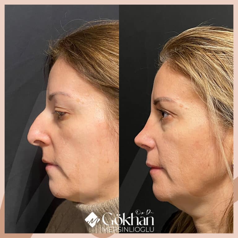 rhinoplasty-before-after